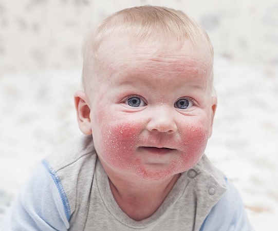 راه ها درمان اگزمای پوست نوزاد