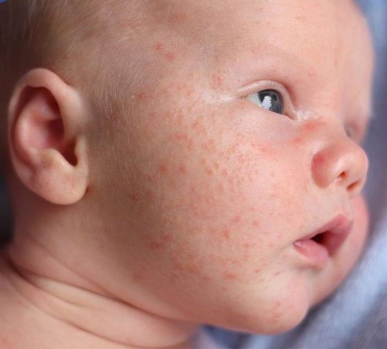 راه های درمان اگزمای پوست نوزاد